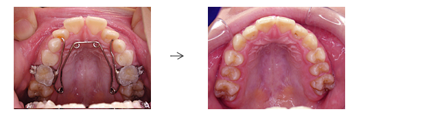 上顎前突（出っ歯）でお悩みの方
