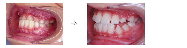 下顎前突（受け口）でお悩みの方