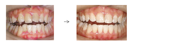 歯がガタガタでお悩みの方（叢生/乱杭歯の症例）