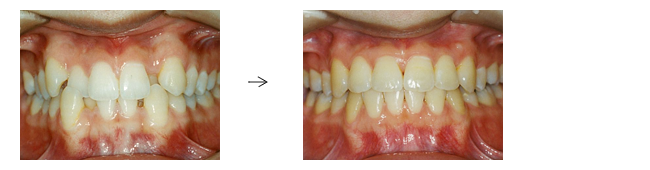 歯がガタガタでお悩みの方（叢生/乱杭歯の症例）
